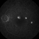 Central Serous Choroidopathy, CSR, with Foci of Leakage