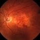 Exudative Macular Degeneration, Prominent Plaque - FC