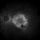 Exudative Macular Degeneration, Prominent Plaque - FA Late