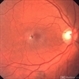 Macular Telangiectasia Type 2