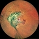 TRACTIONAL RETINAL DETACHMENT TRACTIONAL RETINAL DETACHMENT