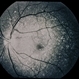 Ring 17 Chromosome Ring 17 Chromosome
