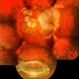 IOL With BAG in Vitreous of Myopic Eye IOL With BAG in Vitreous of Myopic Eye