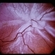 Star Fold, Massive Vitreous Retraction Star Fold, Massive Vitreous Retraction