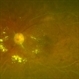 IRVAN Syndrome
