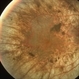 X-Linked Retinitis Pigmentosa X-Linked Retinitis Pigmentosa
