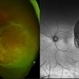 Choroidal Melanoma Choroidal Melanoma