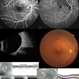 Choroidal-Tuberculoma Choroidal-Tuberculoma