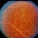 Hyperlipidemia