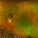 Macula Off Retinal Detachment Macula Off Retinal Detachment