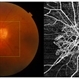 Proliferative Diabetic Retinopathy Showing NVD Proliferative Diabetic Retinopathy Showing NVD