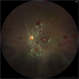 Leukemic Retinopathy - OS
