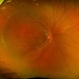 Sturge-Weber Syndrome Sturge-Weber Syndrome