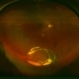 Dropped IOL into the Vitreous Cavity