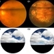 Intravitreous Gas Bubbles
