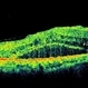 Ischaemic  Diabetic Maculopathy Ischaemic  Diabetic Maculopathy
