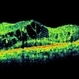 Ischaemic  Diabetic Maculopathy Ischaemic  Diabetic Maculopathy