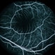 Combined Retinal / RPE Hamartoma Combined Retinal / RPE Hamartoma