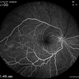 Hemi Central Retinal Artery Occlusion Hemi Central Retinal Artery Occlusion