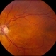 Macular Detachment from Multiple Myeloma