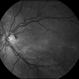 Macular Detachment from Multiple Myeloma