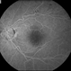 Macular Detachment from Multiple Myeloma