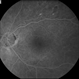 Macular Detachment from Multiple Myeloma