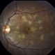 Acute Posterior Multifocal Placoid Pigment Epitheliopathy