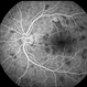 Multifocal Hypofluorescent Lesions
