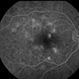 Acute Posterior Multifocal Placoid Pigment Epitheliopathy