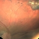 Intraocular Foreign Body, Human Eye Lash, Post Trauma - Right Eye