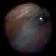 Endoscopic View: the Beginning of Anterior Hyaloid Membrane Pneumatic Dissection Endoscopic View: the Beginning of Anterior Hyaloid Membrane Pneumatic Dissection
