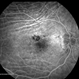 Choroidal Folds in NVAMD
