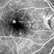Retinal Angiomatous Proliferation in Age-Related Macular Degeneration with Subretinal Neovascularization