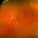 Branch retinal artery occlusion Branch retinal artery occlusion