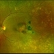 Subretinal Hemorrhage with Chorioretinal Macular Scars Subretinal Hemorrhage with Chorioretinal Macular Scars