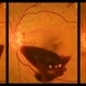 YAG Laser in Preretinal Hemorrhage YAG Laser in Preretinal Hemorrhage