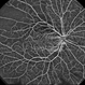 Branch Retinal Vein Occlusion Branch Retinal Vein Occlusion