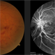 Inferior Hemi-Retinal Vein Occlusion Inferior Hemi-Retinal Vein Occlusion