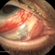 Exposed Scleral Buckle, with Infection  - Infero Nasal View