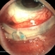 Exposed Scleral Buckle, with Exposed Suture, Infection  - Infero View