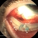 Exposed Scleral Buckle, with Exposed Suture, Infection  - Infero Temporal View