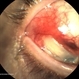 Exposed Scleral Buckle, Infection - Temporal View