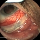 Exposed Scleral Buckle, with Exposed Suture, Infection  - Infero Nasal View, Upgaze