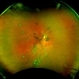 Uveitis