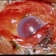 Trauma – Scleral Laceration Trauma – Scleral Laceration