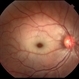Central Retinal Artery Occlusion