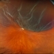 Retinal Detachment Retinal Detachment