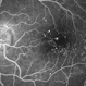 Diabetic Macular Edema, Proliferative Diabetic Retinopathy, Neovascularization Elsewhere, DME, PDR, NVE
