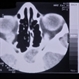 Rhabdomyosarcoma Rhabdomyosarcoma